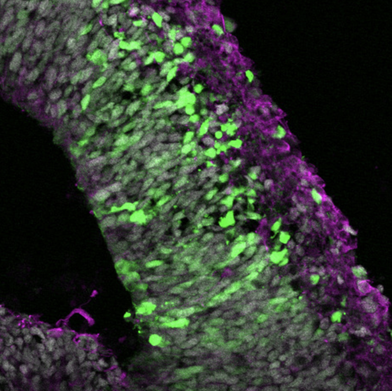 New brain-organoid research helps develop treatments for brain diseases