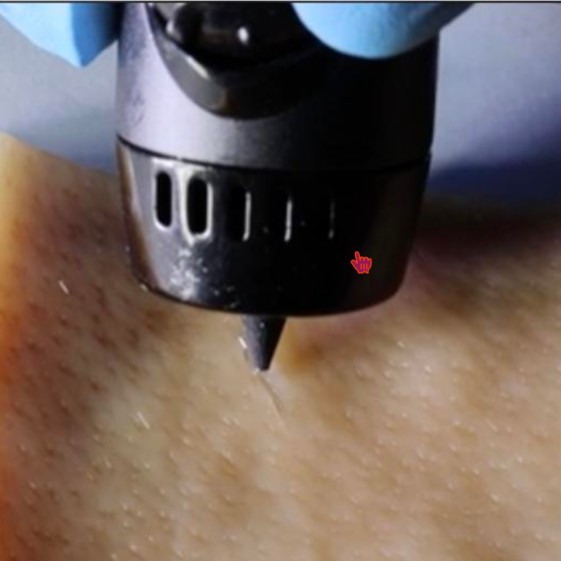 Accelerated wound-healing ink uses 3D-printing pen