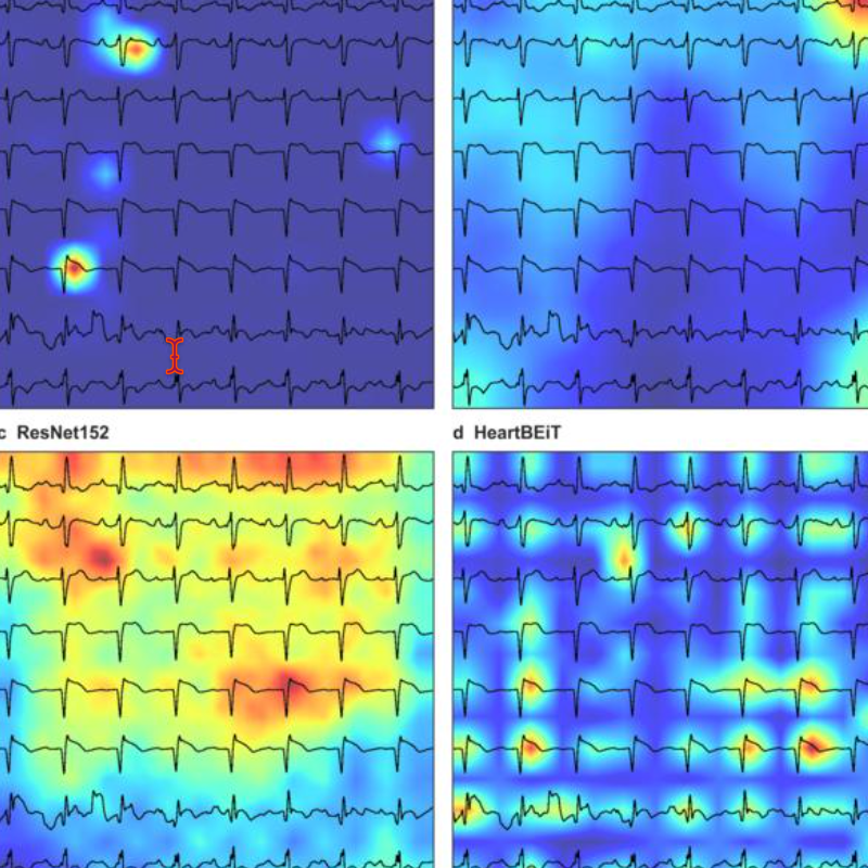 Generative AI Model Radically Improves Electrocardiogram Diagnoses