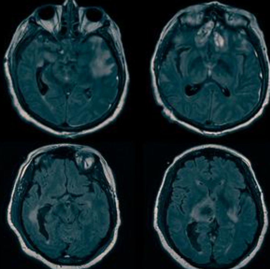 Source of hidden consciousness in ‘comatose’ brain injury patients found