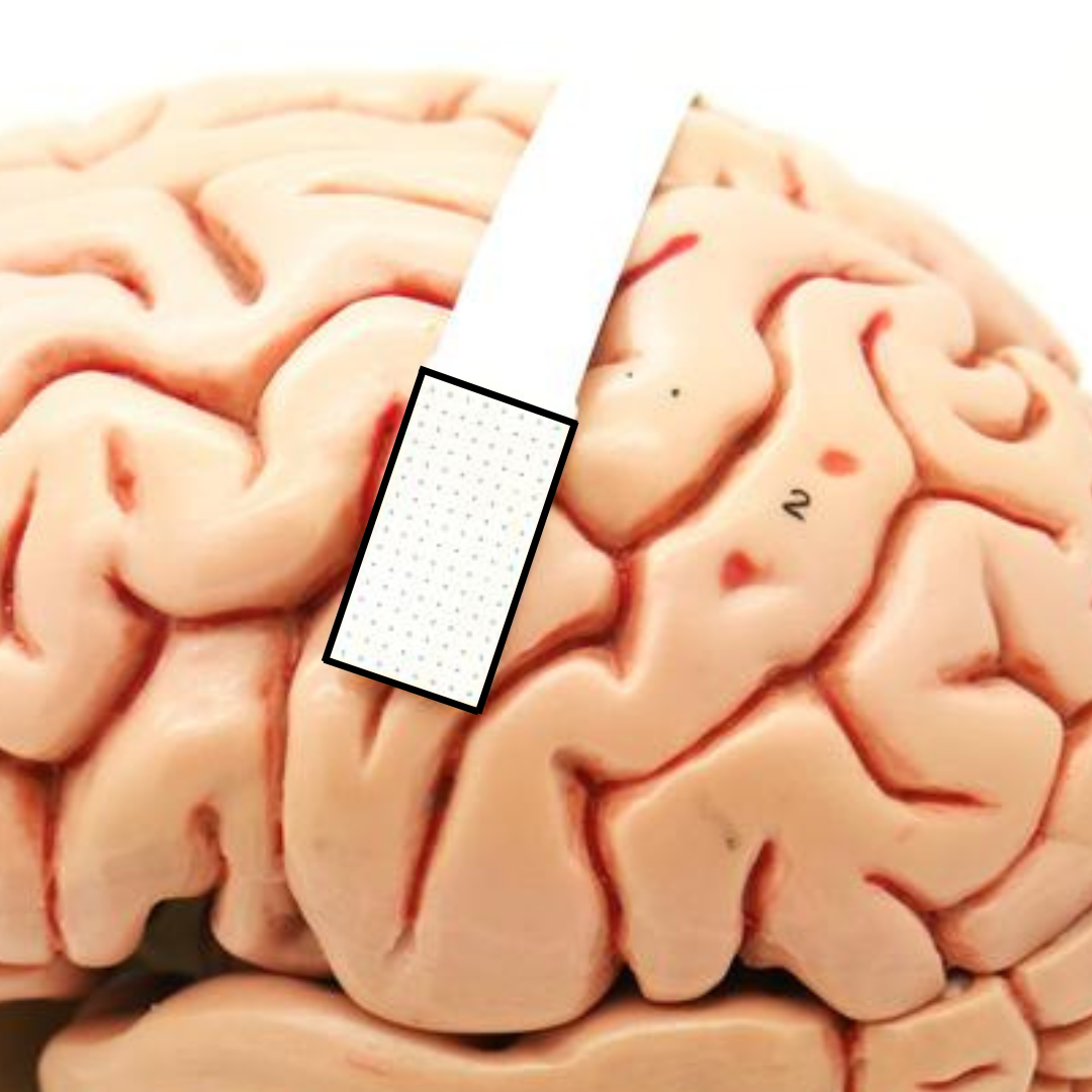 Brain implant may enable fast translation of a patient's thoughts into voiced words