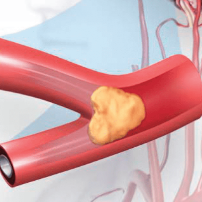 This cancer drug might also treat an ischemic stroke