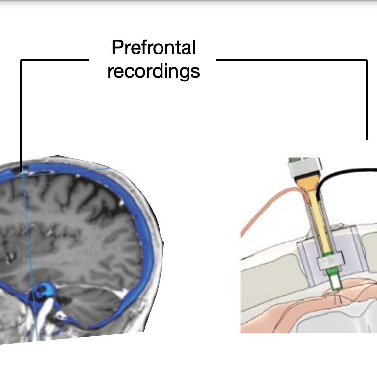Study discovers neurons in the human brain that can predict what you are going to say and help you say it