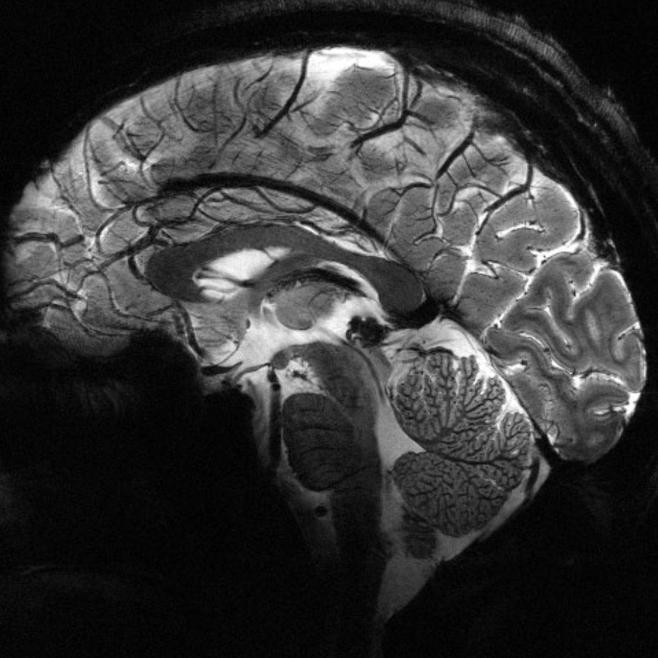 World’s most powerful MRI  scanner images the living brain with unrivaled clarity