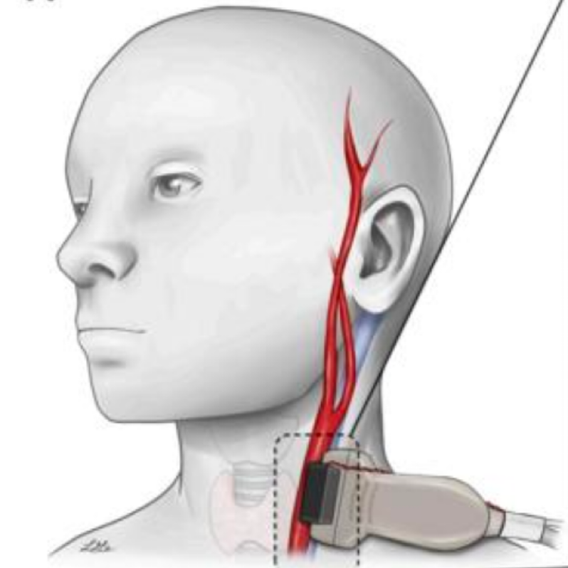 Wearable blood pressure monitor uses ultrasound to capture a continuous record of blood pressure