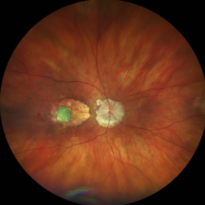 Eye implant developed by BCI startup helps AMD patients see better